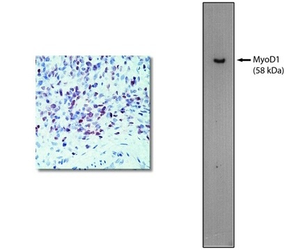 "Left: Immunohistochemical staining using MyoD1 antibody on formalin fixed, paraffin embedded human rhabdomyosarcoma.

Right: Western blot using 60 ng of purified MyoD1 protein with MyoD1 antibody at 2 µg/ml and detected using goat anti-mouse HRP (Cat. No. X1208P) and visualized with Pierce West-Femto substrate."